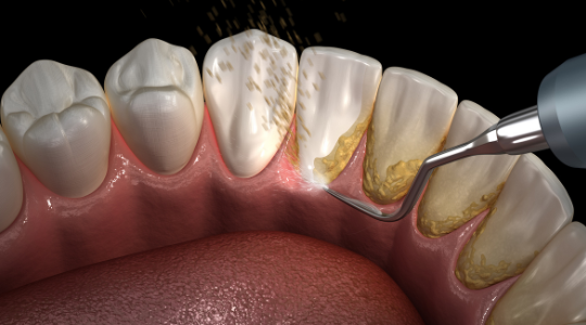 Teeth Cleaning