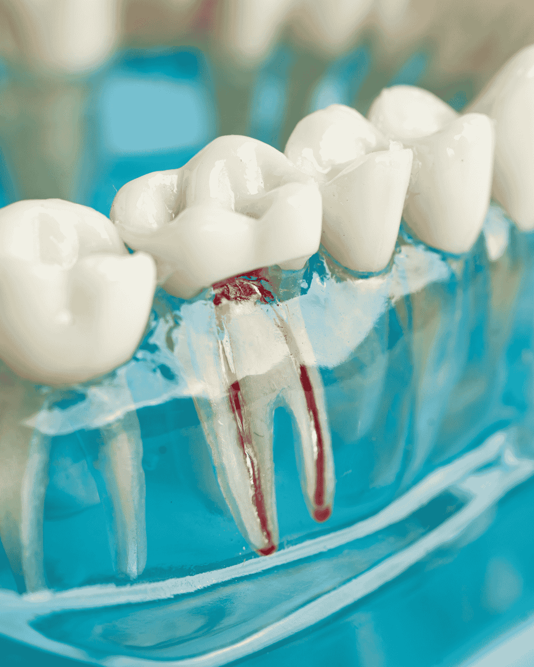 affordable root canal treatment Northcote Northshore Auckland