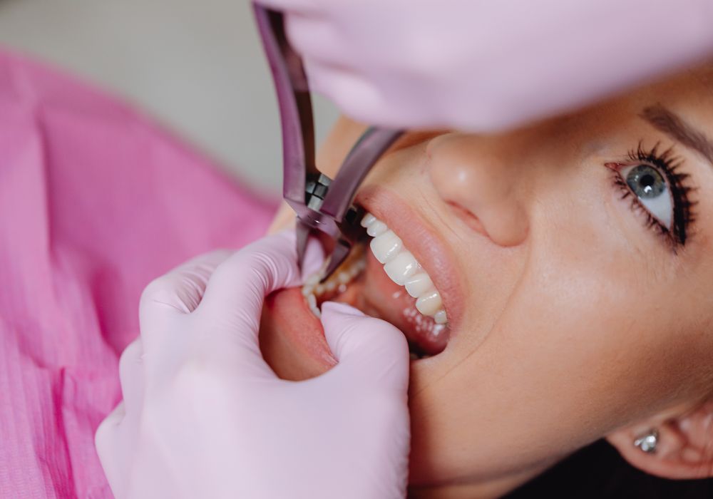 fillings tooth extraction northcote auckland